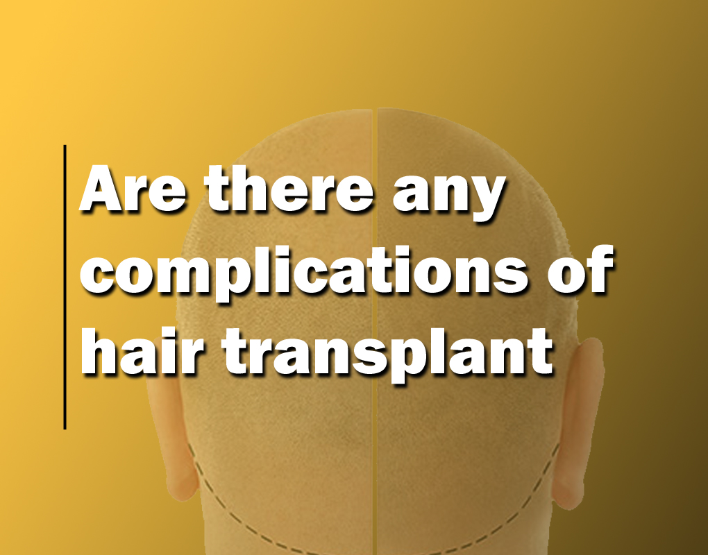 Are There Any Complications With Hair Transplants?