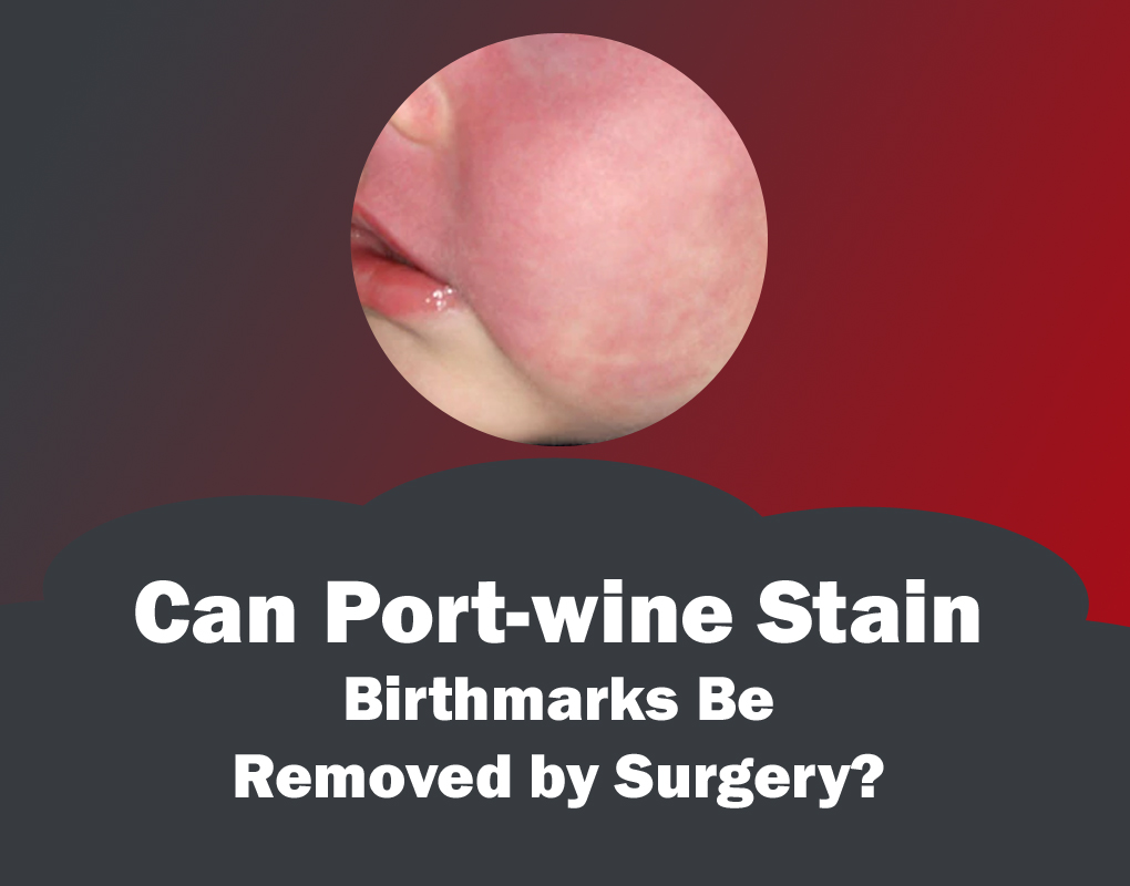 Can port Wine Stain Birthmarks be Removed by Surgery?