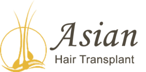 Asian hair transplant 