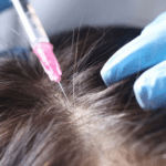 PRP hair treatment