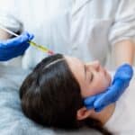 PRP hair treatment in Birmingham