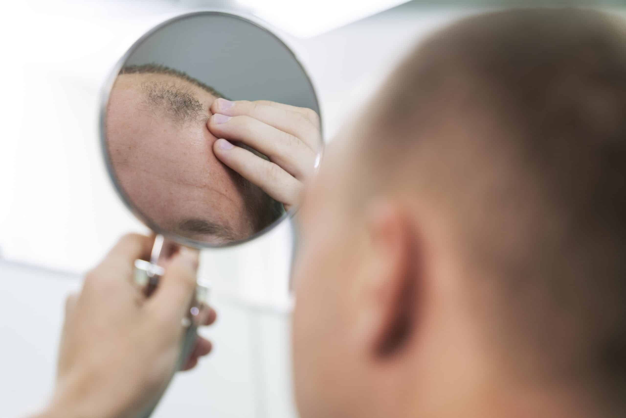 Why Is Hair Transplant in Turkey So Popular?