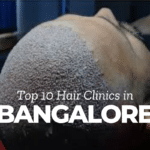 top 10 hair transplant clinics in Bangalore